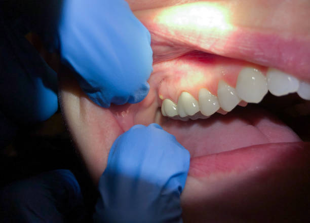 Best Emergency Root Canal Treatment in Waterloo, NE